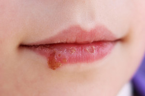 Kandydoza jamy ustnej - objawy i sposoby leczenia