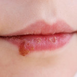 Kandydoza jamy ustnej - objawy i sposoby leczenia