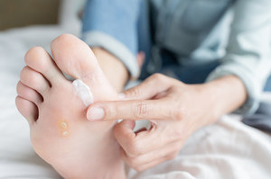 Kandydoza skóry i paznokci może zainfekować cały organizm