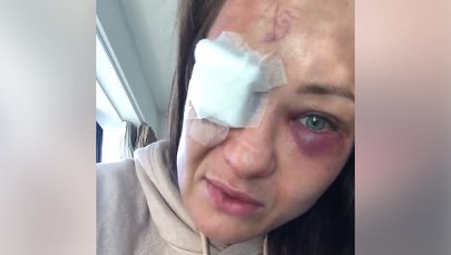 Karolina Kowalkiewicz ma po gali UFC poważne problemy z okiem