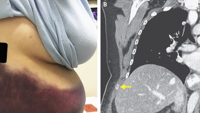 Kasłała tak mocno, że… złamała sobie żebro