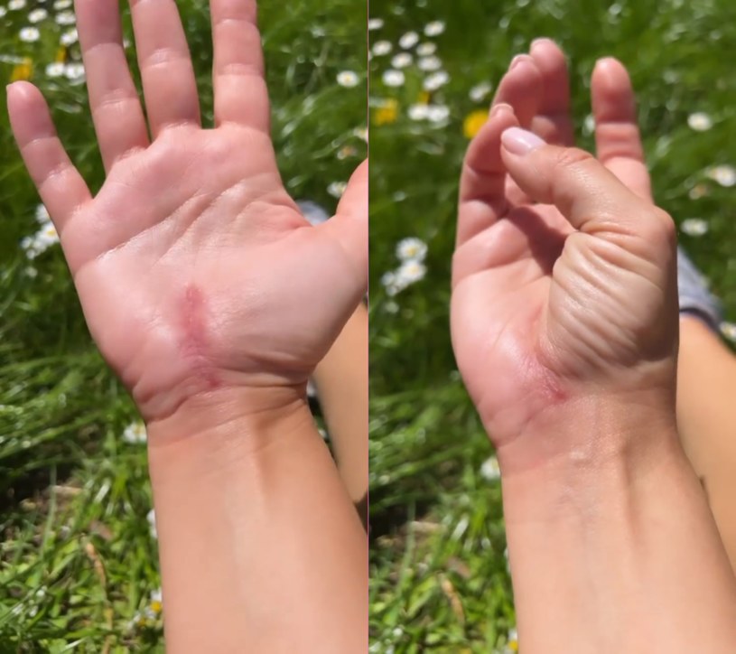 Katarzyna Cichopek pokazuje kojącą się rękę po operacji /@katarzynacichopek /Instagram