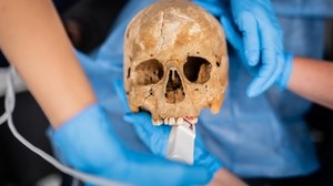 Katowiccy dentyści zbadali zęby średniowiecznych „wampirów”