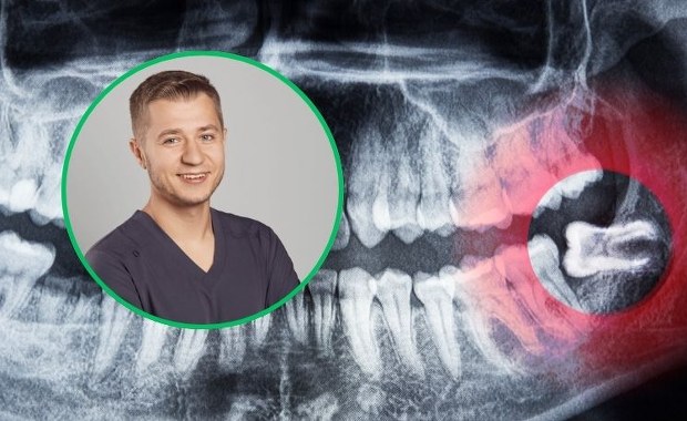Kiedy trzeba usunąć „ósemki”? Chirurg opisuje, jak wygląda zabieg 
