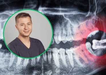 Kiedy trzeba usunąć „ósemki”? Chirurg opisuje, jak wygląda zabieg 