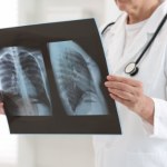 Kiedy zapalenie płuc staje się niebezpieczne? Najważniejsze sygnały ostrzegawcze