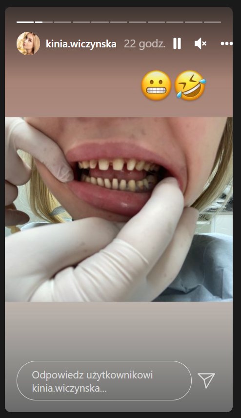 Kinia Wiczyńska spiłowała zęby /Instagram