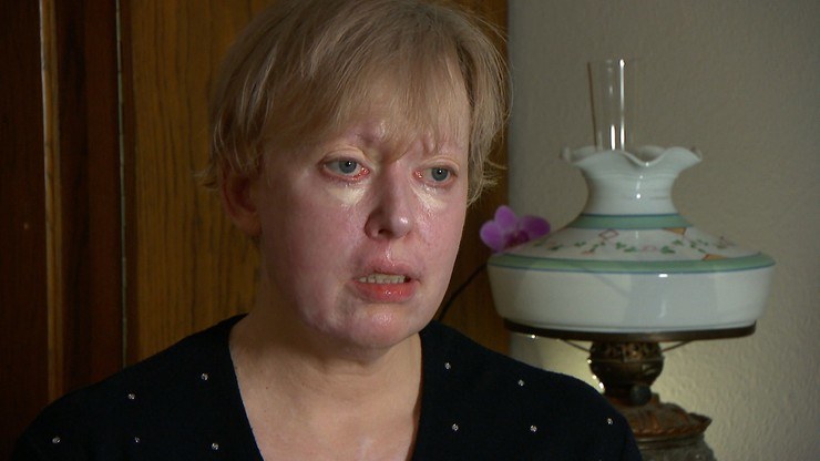 Kobieta po oblaniu kwasem solnym straciła wzrok i pracę. Sprawcy nie ujęto /kadr z programu Interwencja /Polsat News