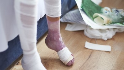 Kolejny tysiąc bezpłatnych opatrunków dla chorych na EB trafi do warszawskiej poradni