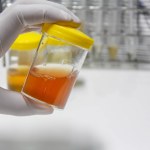 Kolor moczu - co mówi o twoim stanie zdrowia? Jaki kolor moczu jest niepokojący?