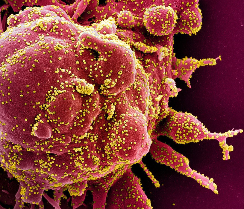 Komórka silnie zakażona koronawirusem SARS-CoV-2 /AFP /East News