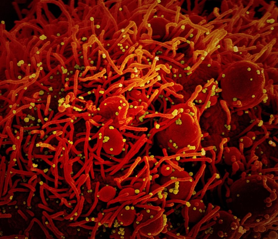 Komórka zainfekowana koronawirusem /PAP/EPA/NIAID/NATIONAL INSTITUTES OF HEALTH HANDOUT /PAP/EPA
