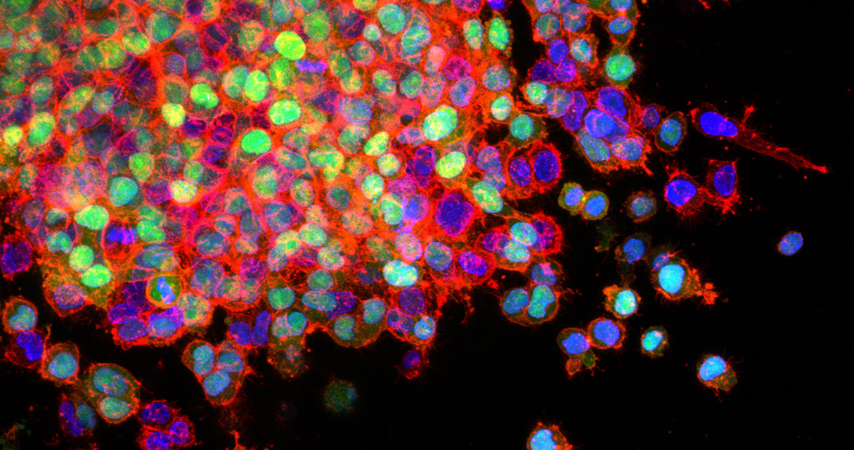 Komórki raka płuc oznaczone białkiem GFP (zielone) /materiały prasowe