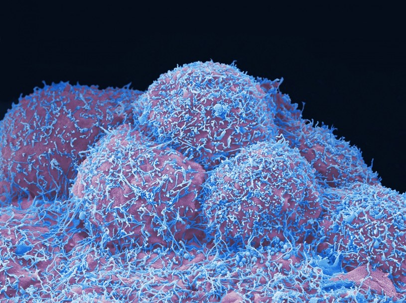 Komórki raka prostaty /Anne Weston, EM STP, the Francis Crick Institute/Science Photo L /East News