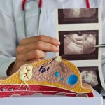 Komórki tłuszczowe mogą zagłodzić raka