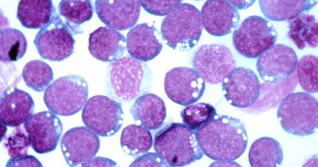 Komórki zawierające EBV /materiały prasowe