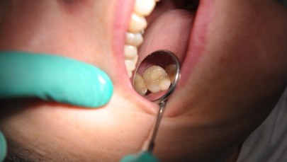 Koniec z czarnymi plombami w zębach u dzieci i kobiet w ciąży. Jest unijny zakaz