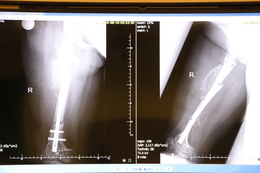Kość wydłużono o trzy centrymetry /Józef Polewka /Józef Polewka, RMF FM