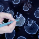 Krok do stworzenia leku na wyjątkowo zabójczego raka mózgu