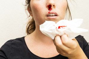 Krwawienie z nosa. Wśród możliwych przyczyn nie tylko uraz