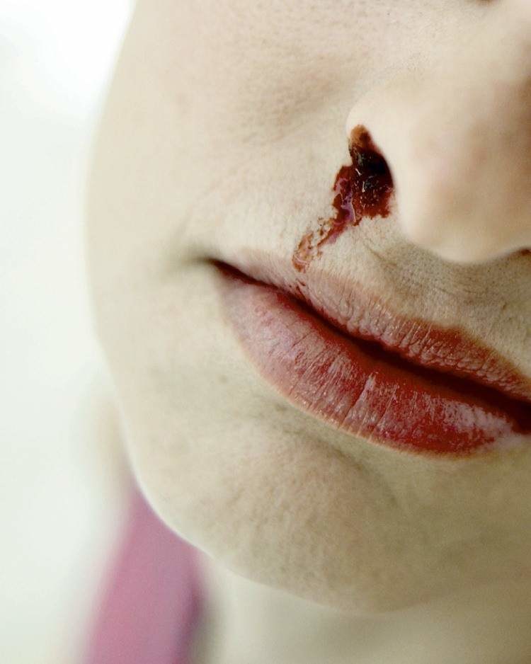 krwawienie z nosa /© Photogenica