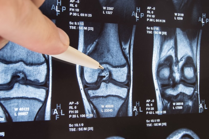 Krwiak w kolanie  może oznaczać uszkodzenie więzadła krzyżowego przedniego /123RF/PICSEL