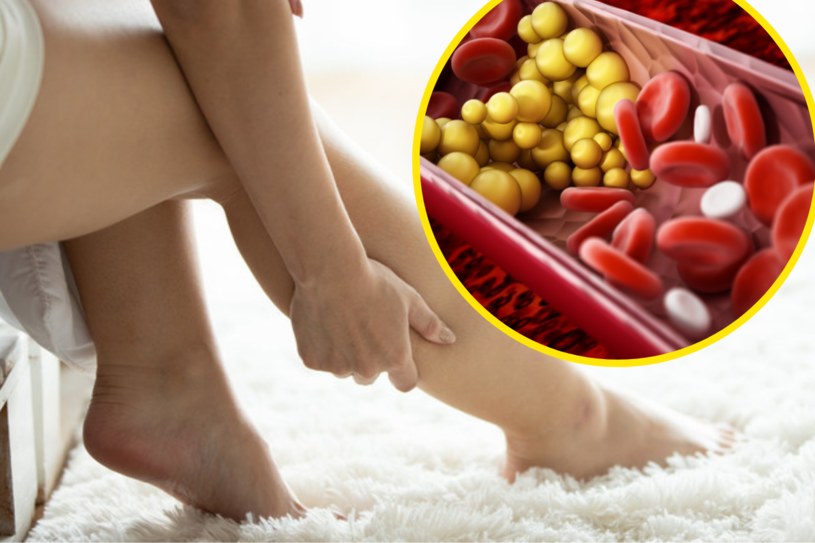 Łapią cię skurcze w nogach? Sprawdź cholesterol i krążenie żylne /123RF/PICSEL