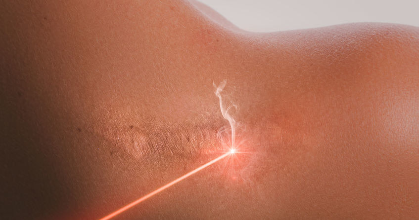 Laseroterapia /&copy;123RF/PICSEL