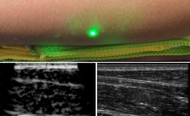 Laserowa ultrasonografia na odległość