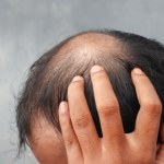 Leczenie łysienia na koszt państwa? Kontrowersyjna propozycja prezydenta