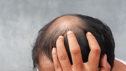 Leczenie łysienia na koszt państwa? Kontrowersyjna propozycja prezydenta