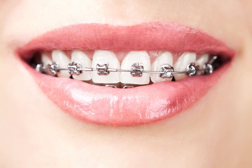 Leczenie ortodontyczne u dorosłych trwa zwykle 2-2,5 roku /123RF/PICSEL
