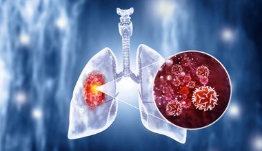 Leczenie raka płuc może być skuteczniejsze dzięki prostemu rozwiązaniu