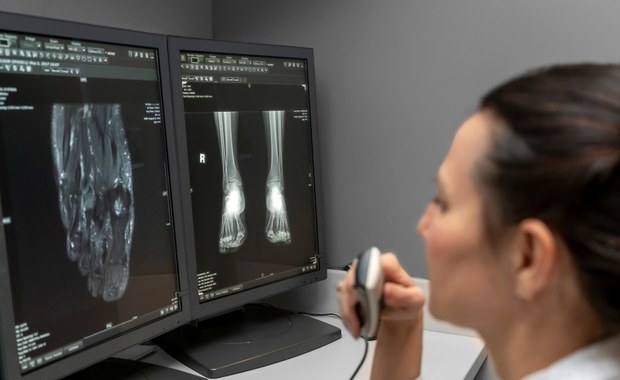 Leczenie złamań kości piętowej. W Polsce możliwe tylko w jednym miejscu