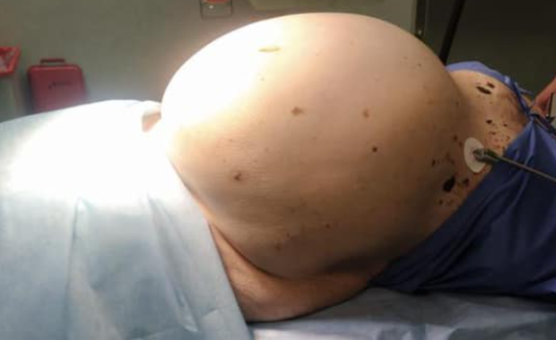 Leczyła się przez teleporady. Urósł jej olbrzymi guz