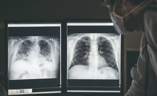 Lek sprzed ponad 70 lat chroni przed uszkodzeniem płuc przez Covid-19