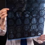 Lekarze już wiedzą. To dlatego kobiety są bardziej narażone na Alzheimera i stwardnienie rozsiane