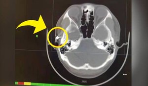 Lekarze mówią o cudzie. Nie do wiary, co znaleźli w jego czaszce