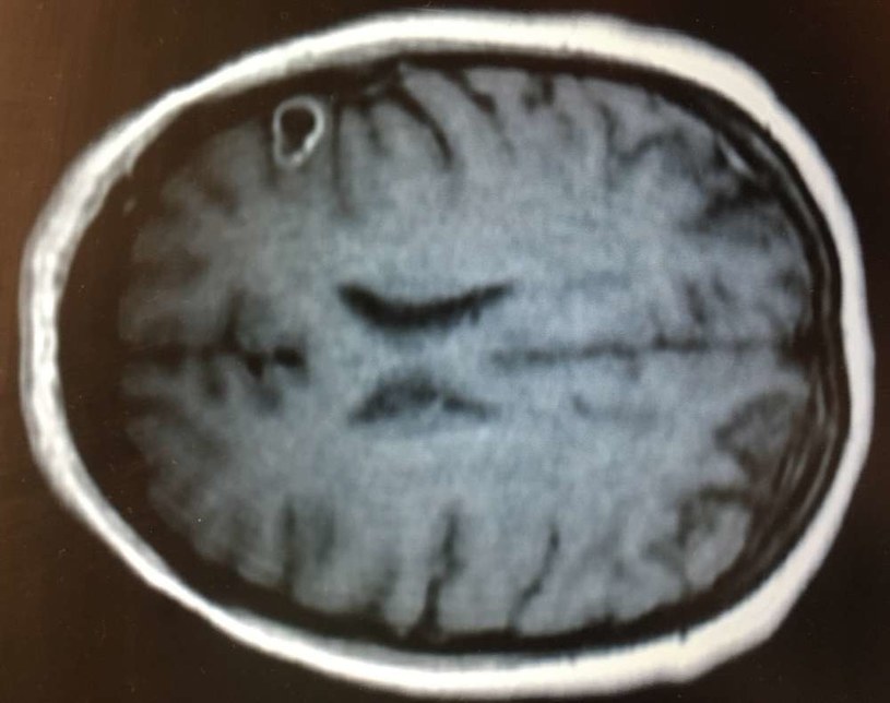 Lekarze myśleli, że to guz mózgu, a tymczasem wycięto jajo tasiemca /materiały prasowe