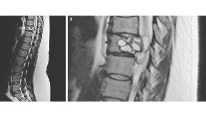 Lekarze nie mogli uwierzyć własnym oczom. W jej kręgosłupie zagnieździł się tasiemiec