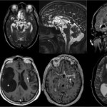 Lekarze podejrzewali nowotwór. Neurocysticerkoza pomylona z przerzutami