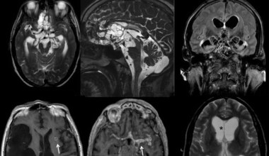 Lekarze podejrzewali nowotwór. Neurocysticerkoza pomylona z przerzutami