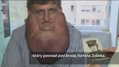 Lekarze usunęli 6-kilogramowy nowotwór! 