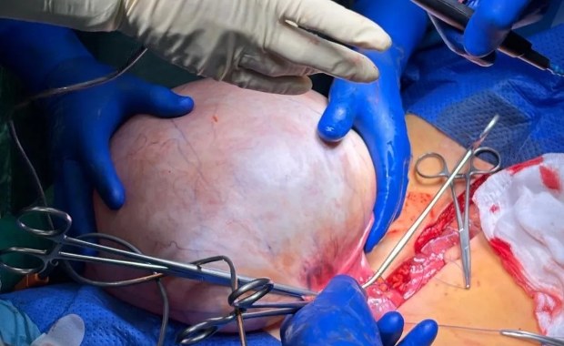 Lekarze usunęli gigantyczny guz jajnika [ZDJĘCIA]