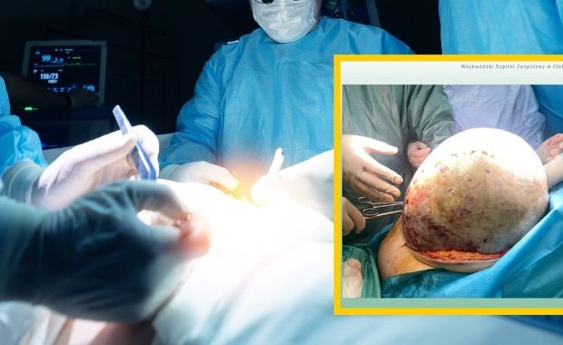 Lekarze usunęli pacjentce 20-kilogramowy guz jajnika