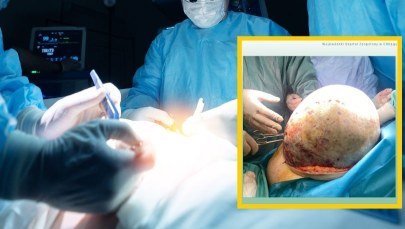 Lekarze usunęli pacjentce 20-kilogramowy guz jajnika