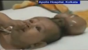 Lekarze usunęli "pasożytniczego bliźniaka" 8-miesięcznego dziecka