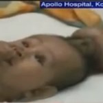 Lekarze usunęli "pasożytniczego bliźniaka" 8-miesięcznego dziecka