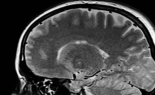 ​Lepsze ukrwienie mózgu może spowolnić rozwój choroby Alzheimera