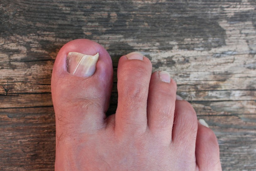 Letnie buty obnażają bolesny problem. Tak wyglądają paznokcie wielu z nas /123RF/PICSEL